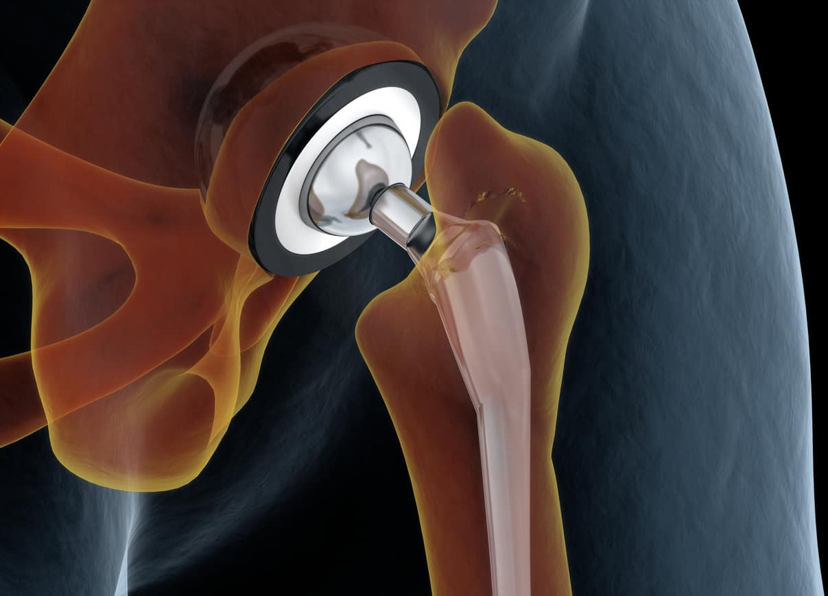What makes you ineligible for a hip replacement?